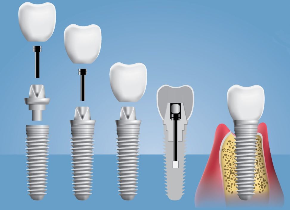 Болезненна ли процедура имплантации? Развеиваем мифы о дентальной имплантации